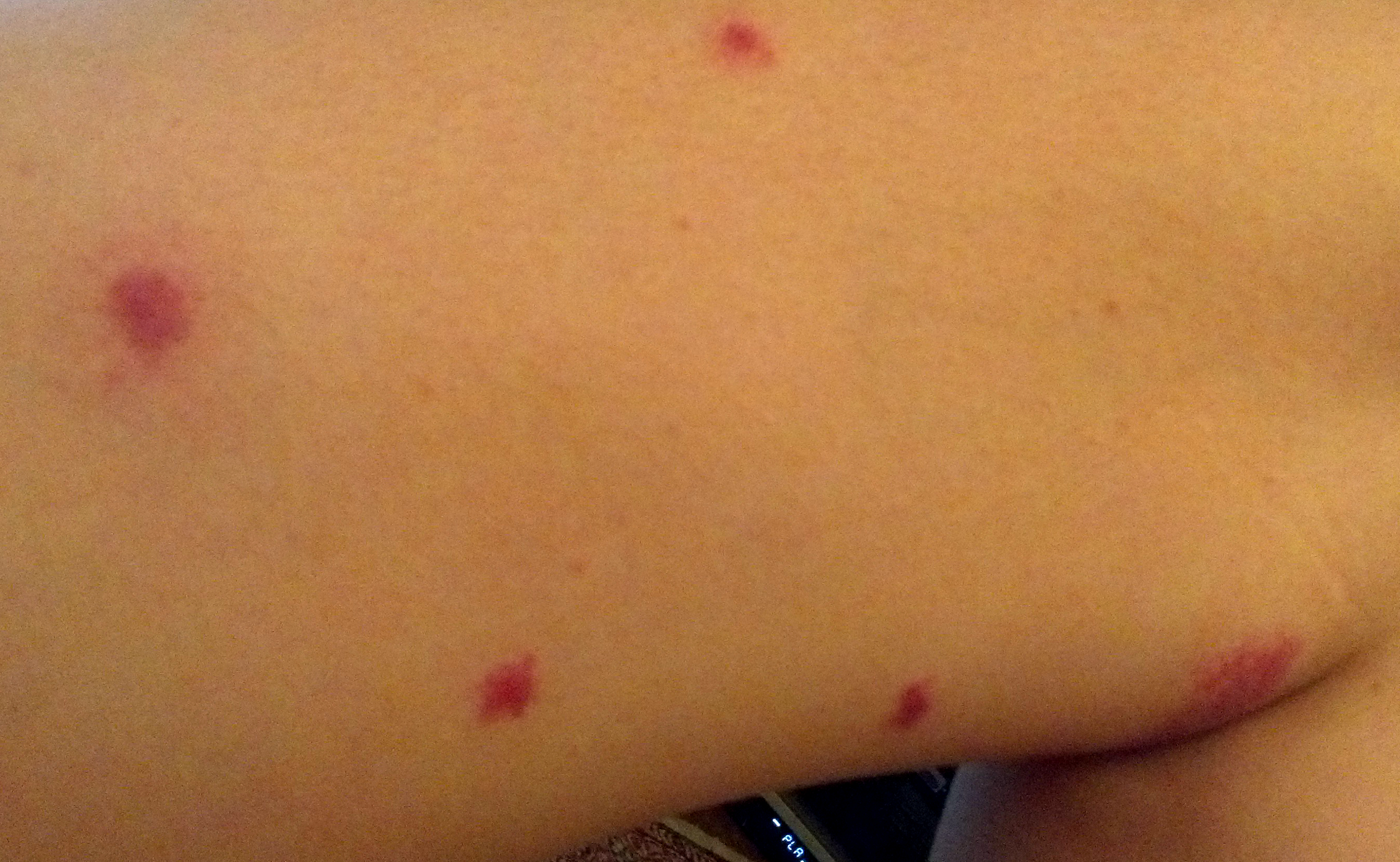 Bed Bug Bites On Neck | Bed Bug Bites Pictures Images | Crazy Gallery